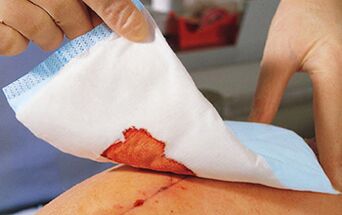 After penis enlargement surgery, it is necessary to perform a bandage