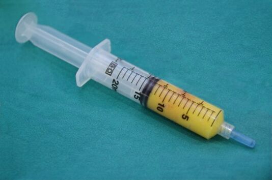 Syringe with adipose tissue for lipofilling
