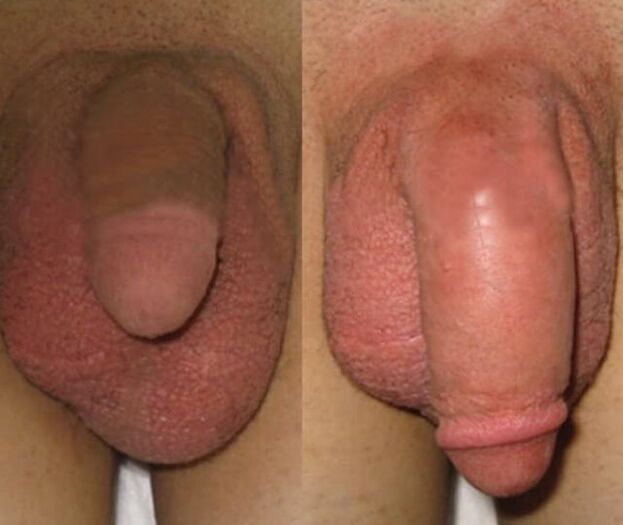 The result of collagen matrix assembly in the penis