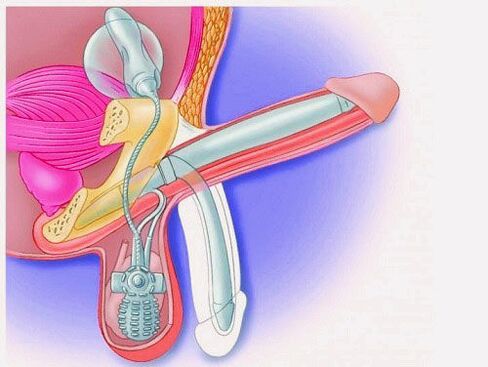 Penis enlargement through a penile prosthesis